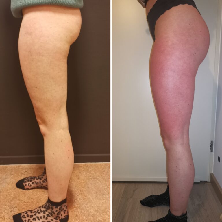 Before &after cuppig en binsweefsel massage